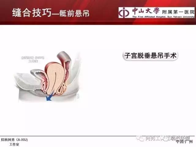 妇科腹腔镜下常用缝合技巧