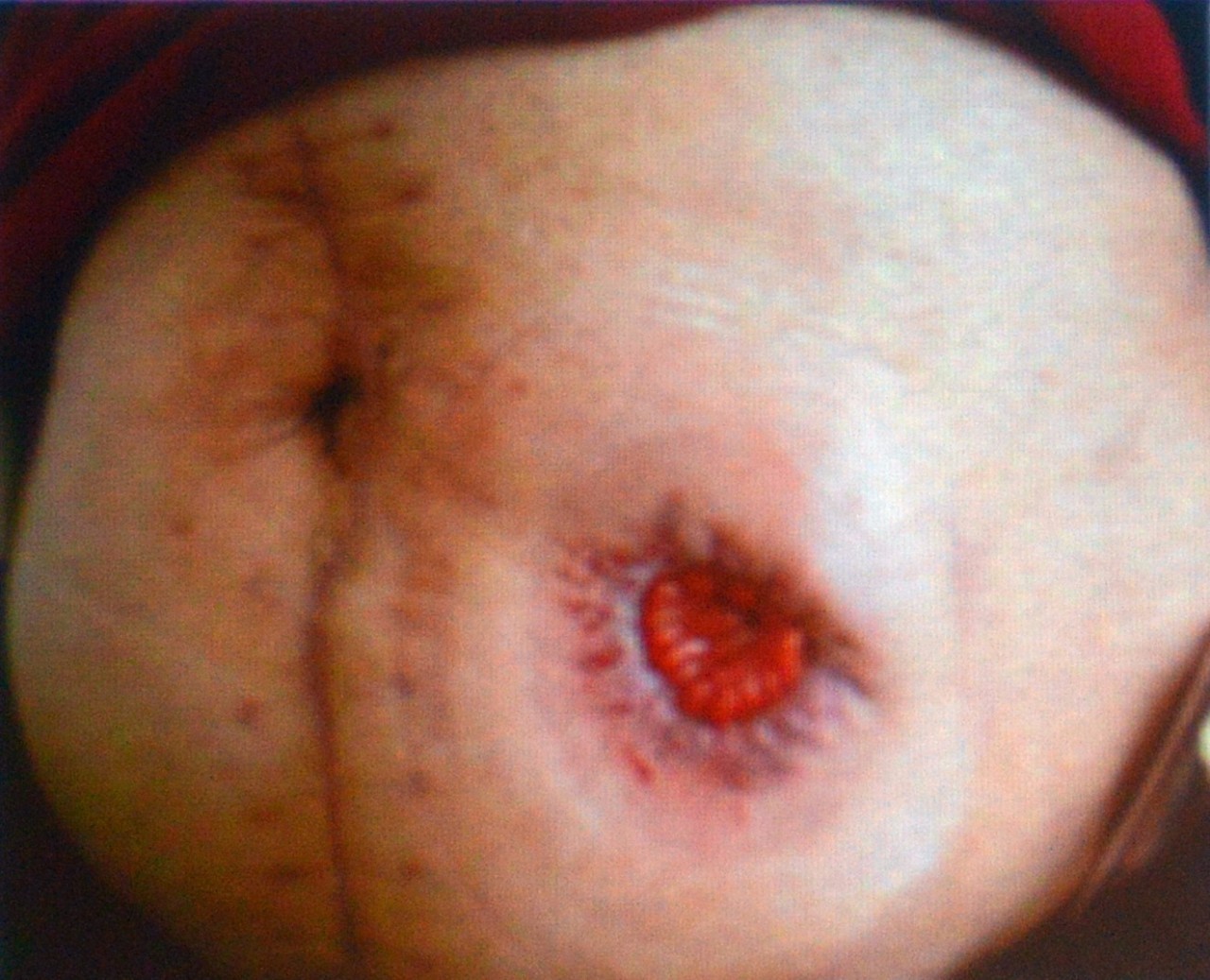 肠造口回纳的并发症是什么,膀胱全切肠造口有什么并发症