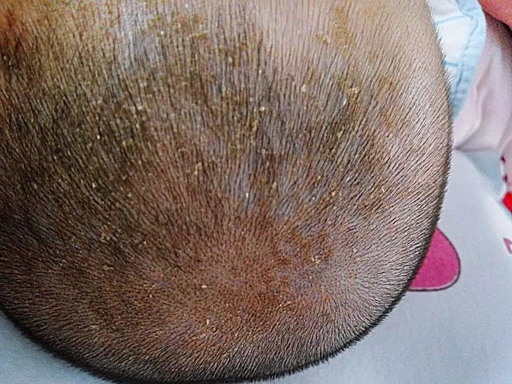宝宝头上有凸起抠下来硬硬的结痂,宝宝头皮上长乳痂正确清理方法