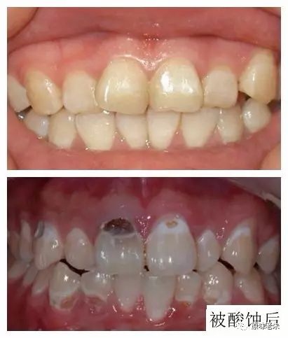 920爱牙日·牙齿酸软请心疼自己，80%的解决办法都在这里了，请自取