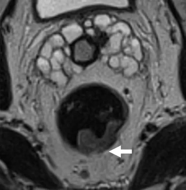 记住一个单词的一般方法,记住癌症九字诀