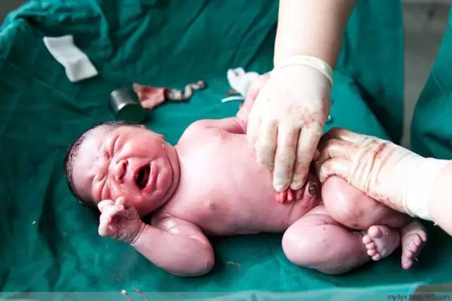 剖腹产全景记录,剖腹产恢复不同时期的照片