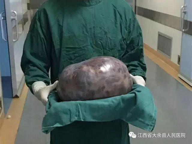 一个女子肚子里有20斤的肿瘤,女子腹中长肿瘤18cm