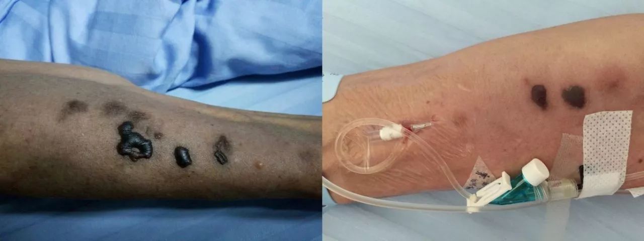 蔗糖铁渗漏如何处理,蔗糖铁的不良反应有哪些