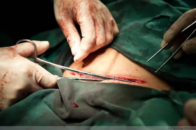 剖腹产全景记录,剖腹产恢复不同时期的照片