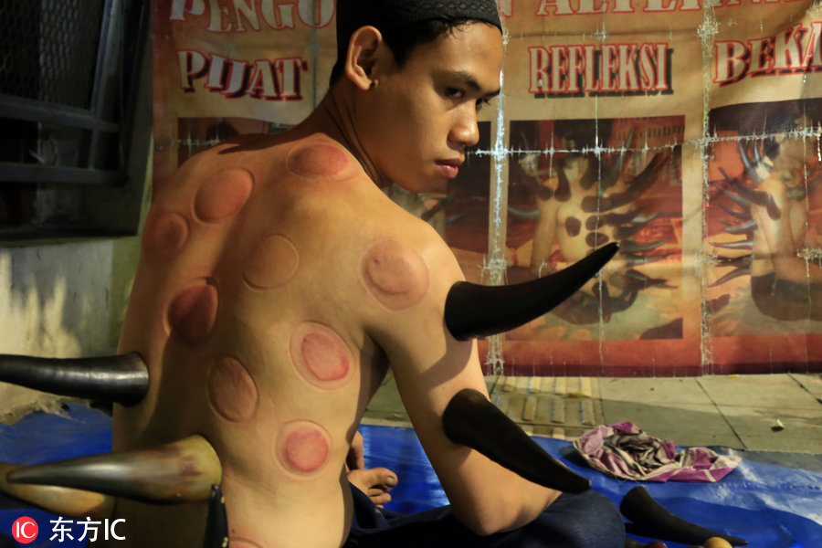 印尼治腰腿疼的药,大连牛角拔火罐疗法