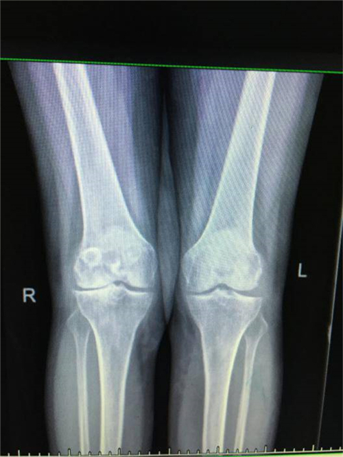 湘雅医院膝关节置换手术案例,赣州膝关节置换手术