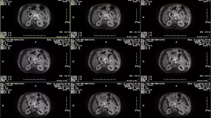 所有检查做完了不知道腹水原因,出现腹水是不是就是晚期了