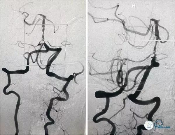 天坛医院脑血管狭窄手术做得好吗,天坛医院动脉狭窄介入手术费用