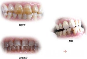 拯救四环素牙,四环素牙的完美蜕变过程