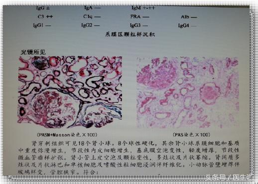 糖尿病酮症酸中毒病人伴有肾衰竭,糖尿病引起急性肾衰竭可以恢复吗