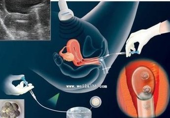 试管婴儿移植后出血，代表移植失败吗？