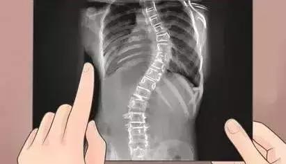 成人脊柱侧弯手术可以彻底治愈吗,中医推拿正骨可以治愈脊柱侧弯吗