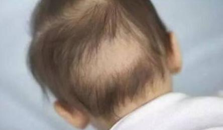 宝宝头发稀疏发黄怎么改善,宝宝头发黄怎么理