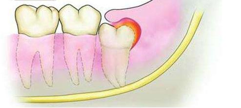 舒卿治疗牙疼牙龈肿痛,治疗牙龈肿痛的小方法