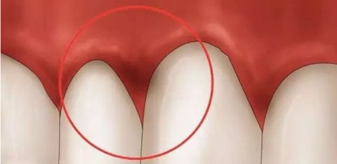 舒卿治疗牙疼牙龈肿痛,治疗牙龈肿痛的小方法