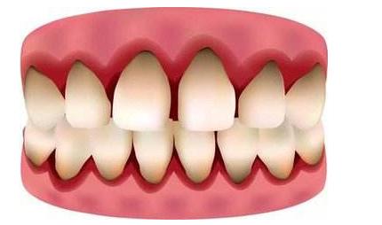 鐗欓緢鑲跨棝鎬庝箞杩涢,鐗欓緢鑲跨棝鎬庝箞杩涜娌荤枟