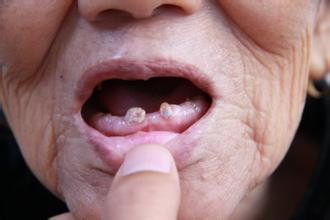 反复口腔溃疡要做什么检查,反复发作口腔溃疡开刀