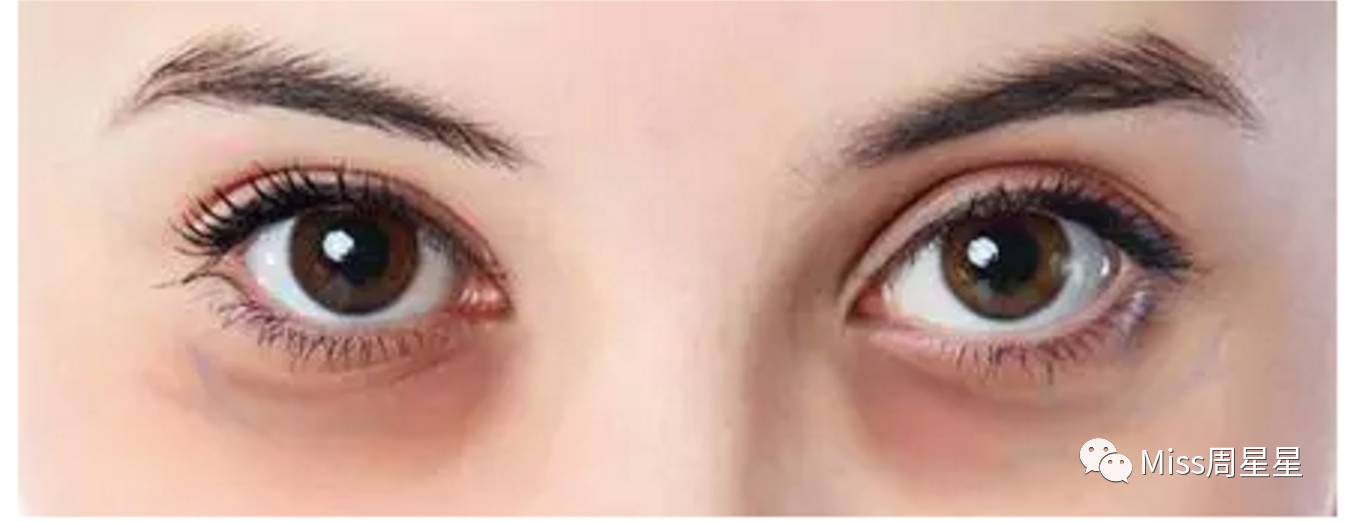 严重黑眼圈的治愈经历,千年黑眼圈解决方案