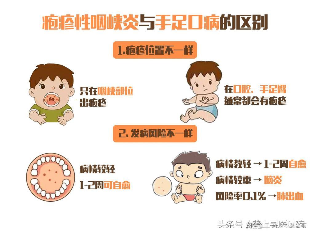 疱疹性咽峡炎高烧不退是怎么回事,宝宝高烧不退一定要小心这种病