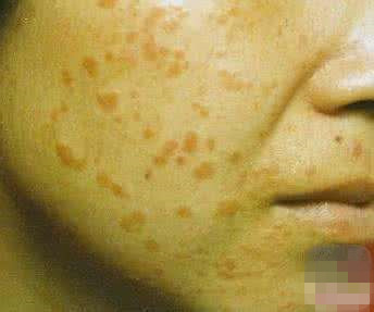 理发师号称养生治疾病,骗女子*款贷**20万办疗程,到底是什么病