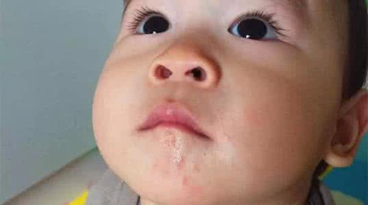 五个半月严重的口水疹怎么办,宝宝口水疹湿疹怎么护理最有效