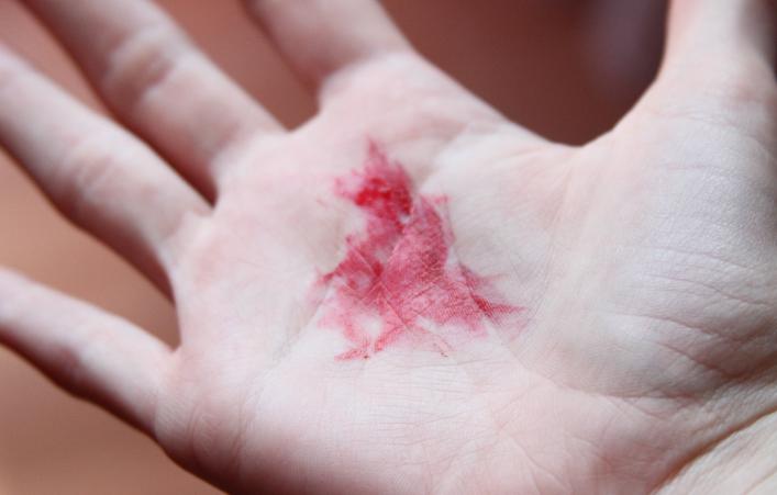 小孩咳嗽有红色的痰是怎么回事,咳出来的痰是黄红色的是怎么回事