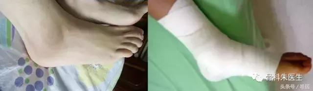 脚踝关节扭伤无骨折怎么恢复快,踝关节扭伤康复治疗注意事项