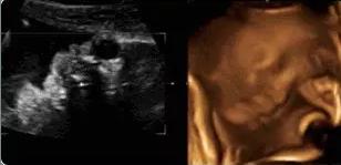 孕期做四维彩超宝宝不配合怎么办,四维产检宝宝不配合怎么办