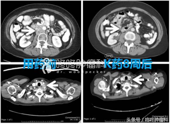 怎样知道pd-1治疗有效,怎么判断pd1免疫治疗有效