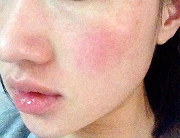 皮肤敏感自救指南,皮肤敏感的解决思路