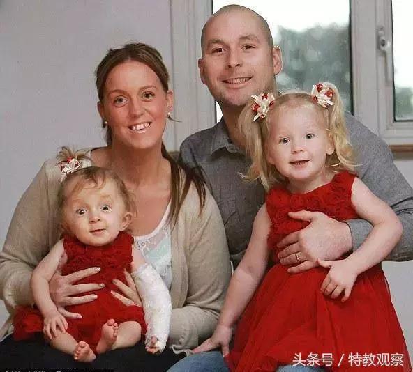 小孩脆骨症怎么治疗,脆骨症孩子