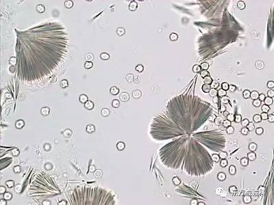 尿中结晶达到多少就是结石了,尿结晶数高是病吗