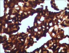 肿瘤病人案例,肺癌会转移到子宫内膜癌吗