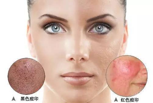 教你快速祛痘印最有效的方法,如何祛痘不用任何产品祛痘印