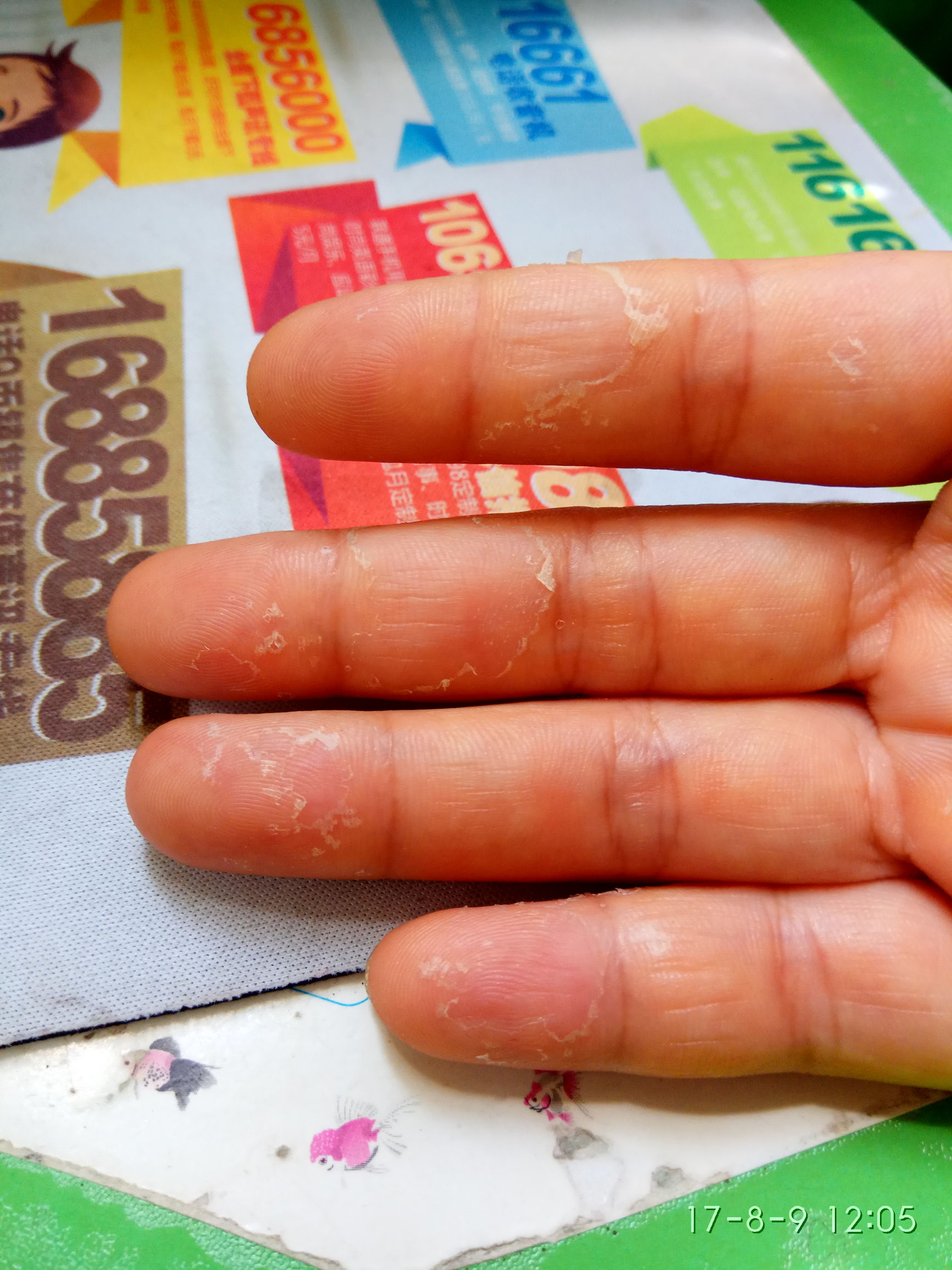 小宝贝手指脱皮是什么情况,宝贝手指头脱皮怎么回事