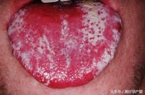 清理宝宝舌头奶渍能预防鹅口疮吗,宝宝鹅口疮治疗和预防攻略