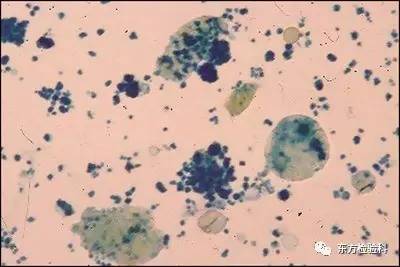 尿中结晶达到多少就是结石了,尿结晶数高是病吗