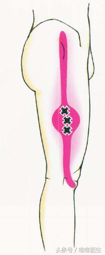 膝盖疼痛治疗经验分享,膝关节总结