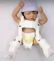 宝宝腿纹不对称是拍ct还是彩超,腿纹不对称但是双腿蹬起来很有力