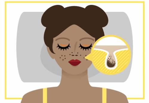 脸上反复起脓包黑头粉刺怎么回事,青春期孩子脸上的黑头粉刺怎么办
