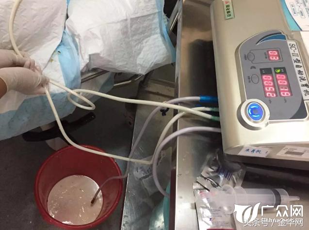 浙江一65岁大伯喝了口“水”医生用4箱牛奶给他洗胃