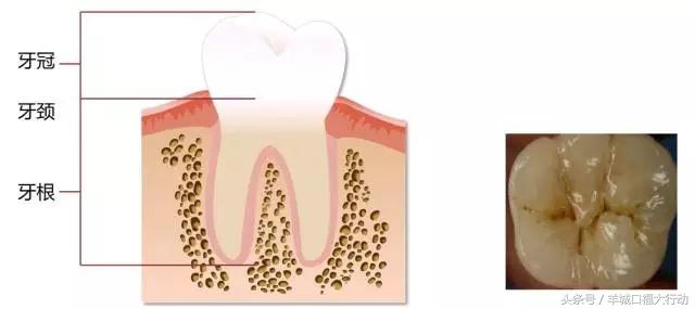 龋齿蛀牙有虫吗,科普蛀牙的形成