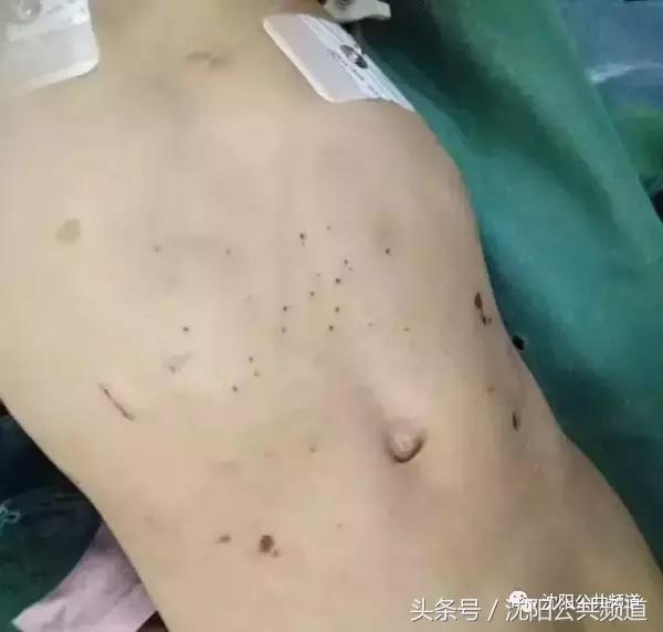 8岁孩子被成年人殴打颅内出血,男童被亲妈虐待致颅内出血