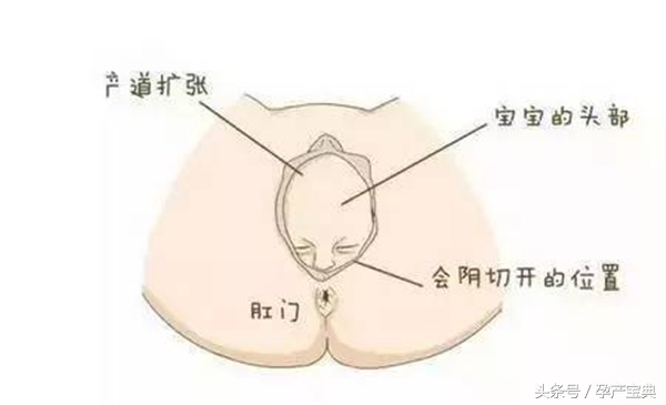 顺产侧切不可怕，关键是要掌握好会阴恢复之法！