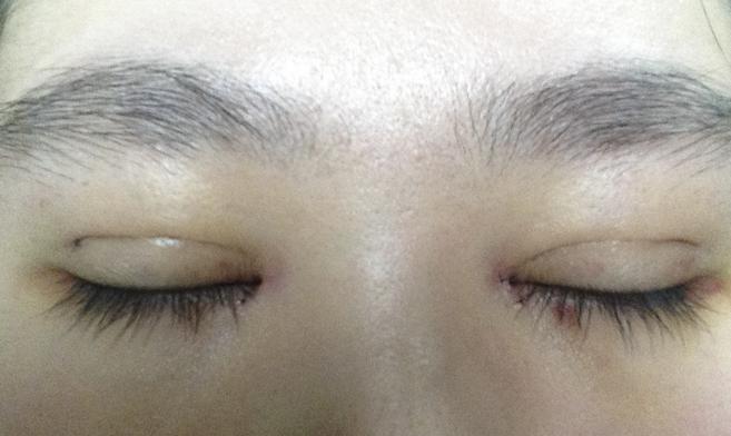 微整是怎么做到无痕的,微整怎么辨别