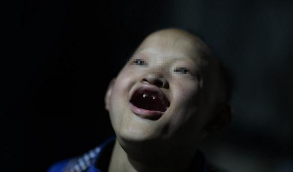 25岁小伙得了罕见病,男子患怪病一睡觉就满口血