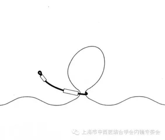 内镜套扎是什么,内镜套扎器械