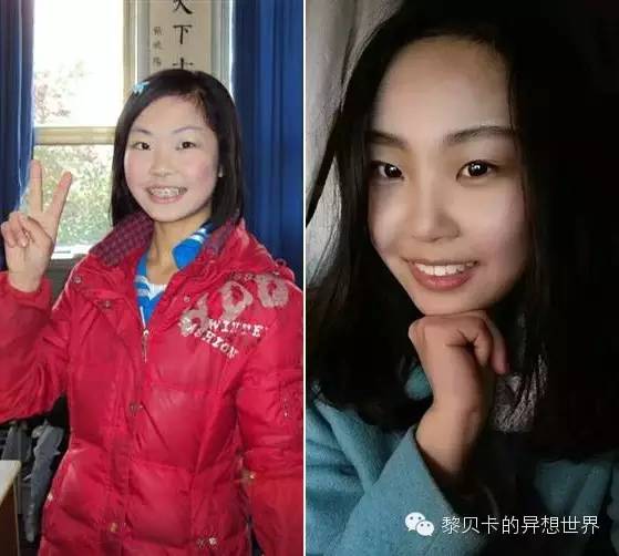 她们说||那些年整牙吞下的血和泪,终于换来最开怀的大笑