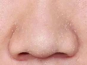 医生告诉你5个祛黑头的正确方法,试试这3招很有效的去黑头小妙招